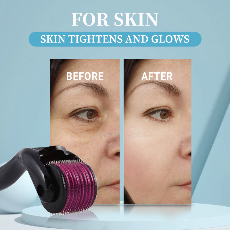 Micro Needling 540 Roller Derm - Derma Roller 0.25 recensie en prijs